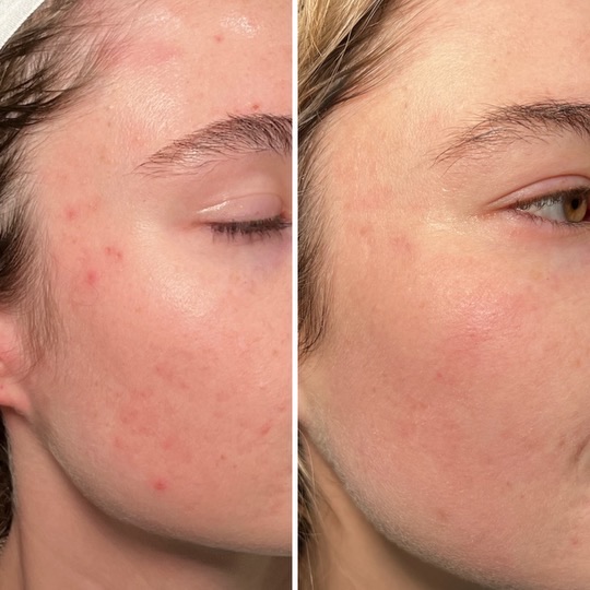 Foreverclear Before and after