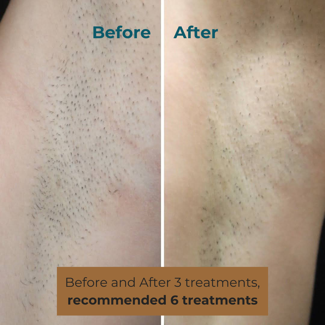 Forever Bare Armpit Treatment