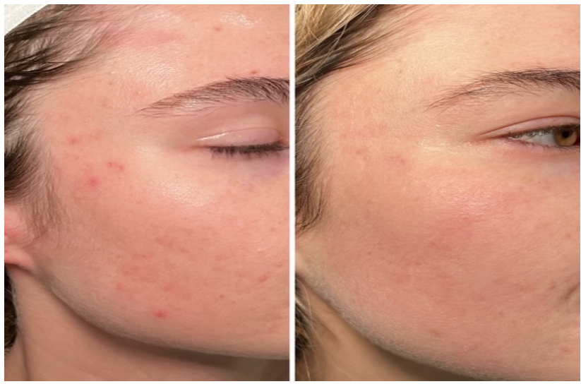 Foreverclear Before and after